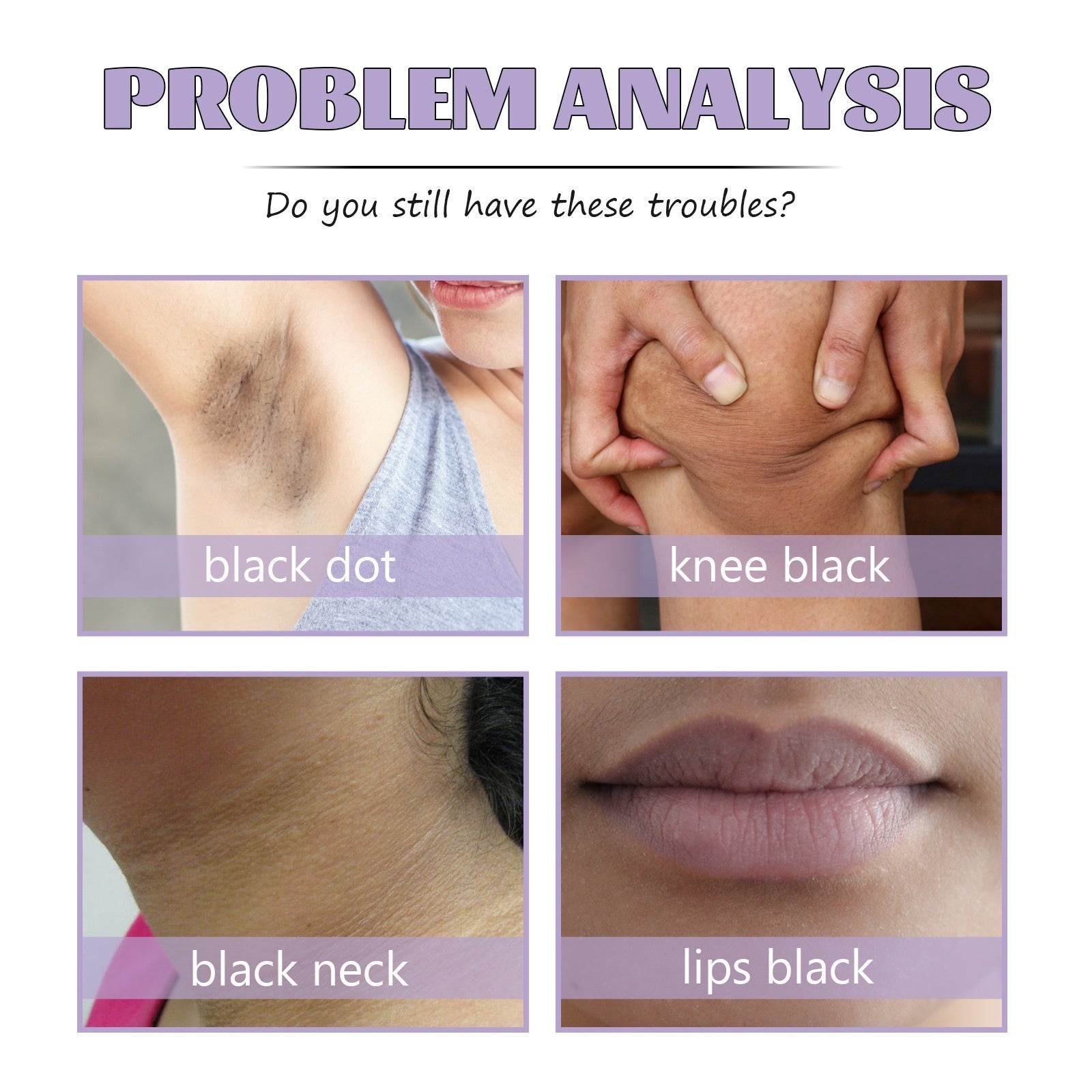Black Spot Cream Fade Black Spot Knee Elbow Brighten Skin Color